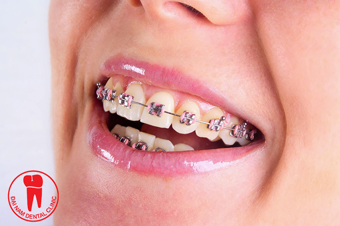 Niềng răng sứ giá bao nhiêu tại nha khoa Đại Nam